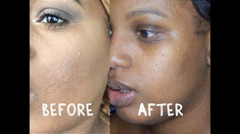 How I Cleared My Skin Got Rid Of Texture 6 Easy Steps Youtube