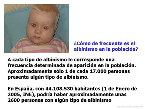 Albinismo Informacion E Investigacion