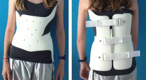 Scoliosis Brace System Kk Prosthetic And Orthopaedic Equipment