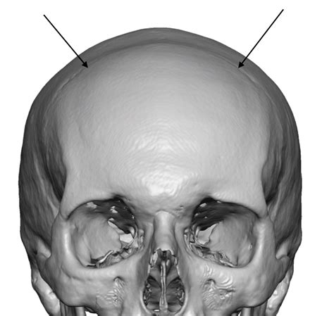 Coronal Dip Skull Defect Front View 3d Ct Scan Dr Barry Eppley