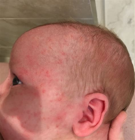 Newborn Acne Or Allergy Breastfed Baby