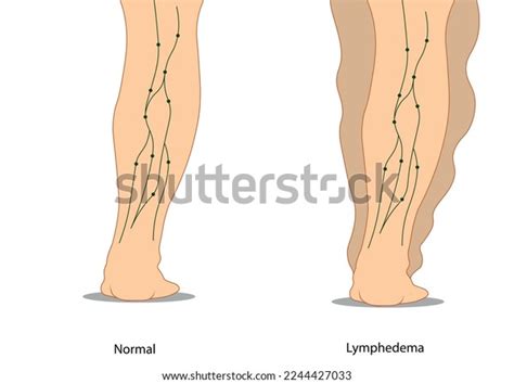 Lymphedema Illustration Compared Normal Leg Stock Vector Royalty Free