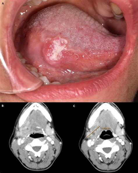 Oral Squamous Cell Carcinoma Floor Of Mouth