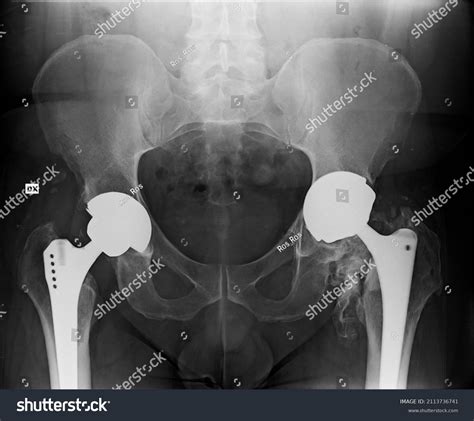 Pelvis Adult Bilateral Total Hip Replacement Stock Photo 2113736741