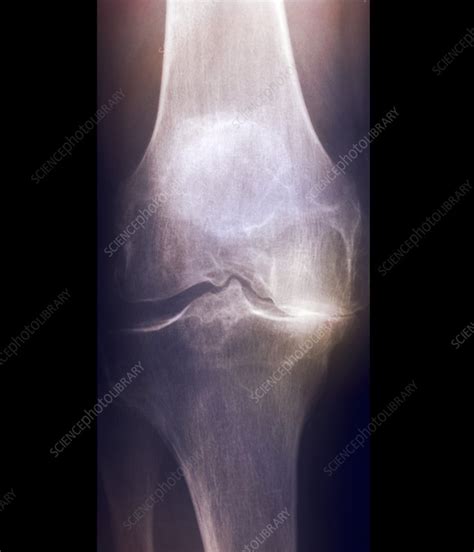 Arthritis Of The Knee X Ray Stock Image F0033497 Science Photo