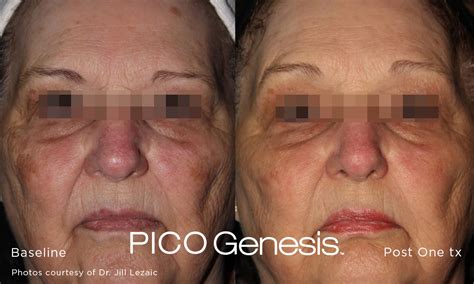 Pico Genesis Nw Calgary Fresh Laser Skin Studio