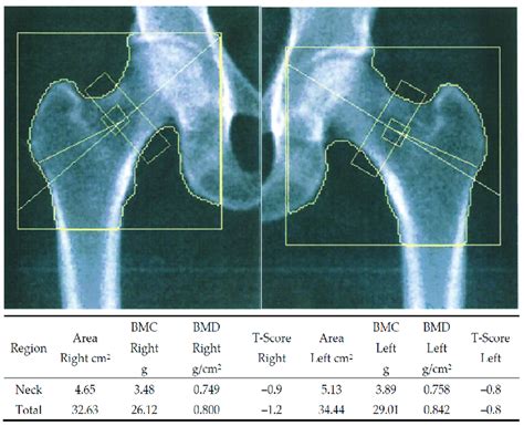 Bilateral Hip Dxa Scan Image From A 59 Year Old Post Menopausal Woman