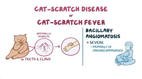Bartonella Henselae Cat Scratch Disease And Bacillary Angiomatosis