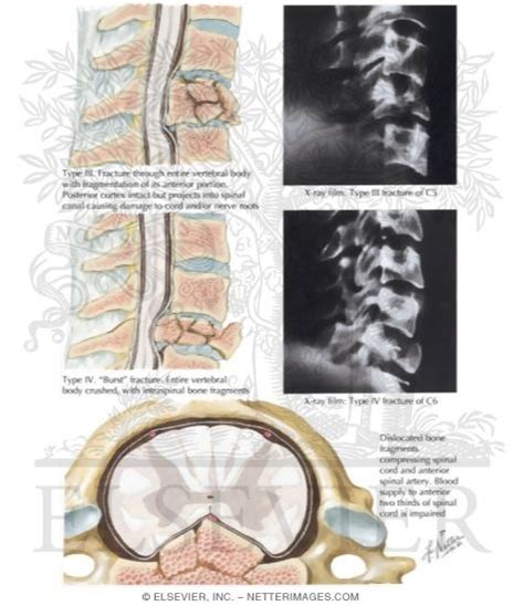 Compression Fractures Of Cervical Spine