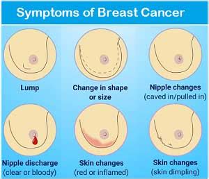 Dimpling and puckering are among the skin changes that can occur with breast cancer. Breast Cancer | Causes, Symptoms, Signs, Stages, Treatment ...