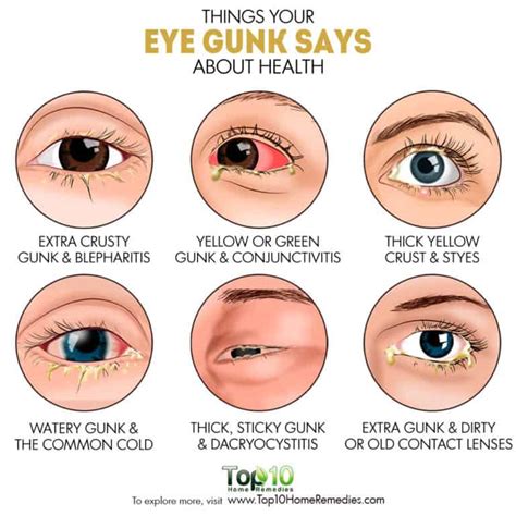 Things Your Eye Gunk Says About Health Top 10 Home Remedies