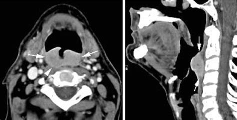 Contrast Enhanced Ct Images In A Patient With Cancer Of The Posterior