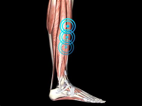 Muscles Medial Tibial Stress Syndrome