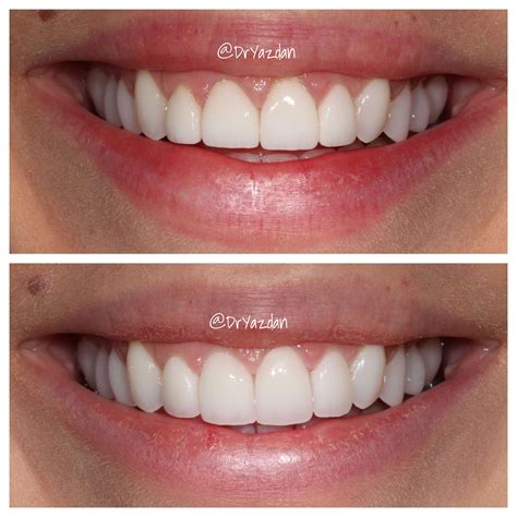 Porcelain veneers are expensive and can cost between $700 to $2,500 per tooth. Replacing 4 old monochromatic veneers with newer shades of ...