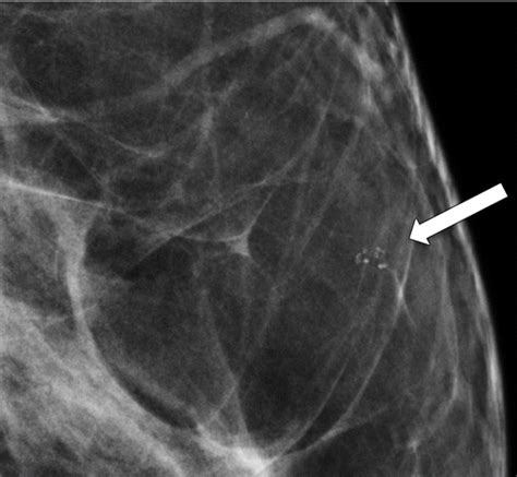 Calcifications At Digital Breast Tomosynthesis Imaging Features And Biopsy Techniques