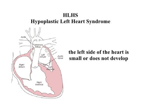 Hlhs Hypoplastic Left Heart Syndrome