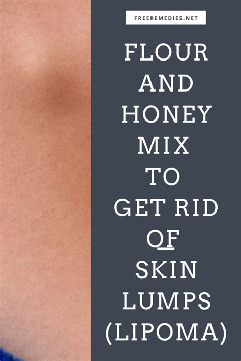 Flour And Honey Mix To Get Rid Of Skin Lumps Lipoma Freeremedies