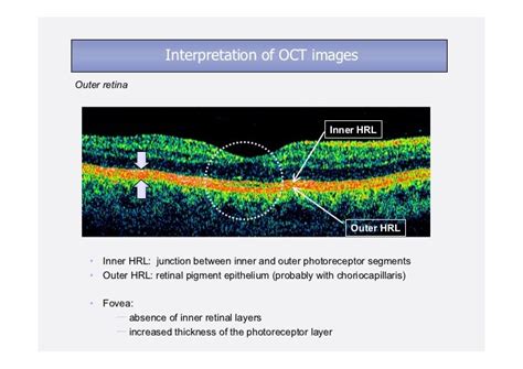 İnterpretation Of Optic Coherence Tomography Images