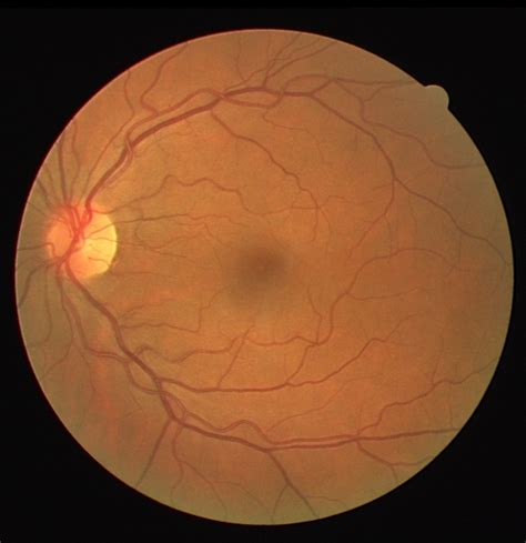 Retinal Fundus Images Of The Onh Normal And Pathological Eyes 5