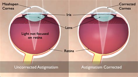 What Is Astigmatism And How To Fix It Guides And Videos