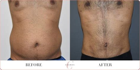 Liposuction Love Handles Men Before And After