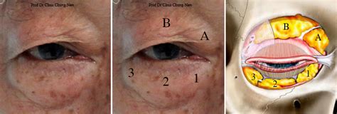 Eyelid Surgery By Prof Dr Cn Chua 蔡鐘能 Doc What Are These Swellings In