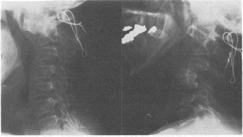 Left Lateral Radiograph Of Patient In 1976 Foliowing A Posterior