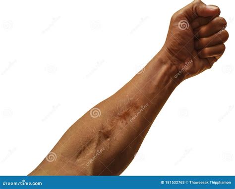 Scars On The Skin Of The Arm Stock Image Image Of Incision Patient