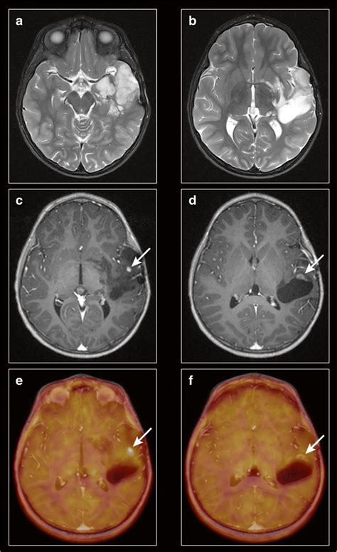 Axial T2 Weighted A B And T1 Weighted Post Gadolinium C D Mri