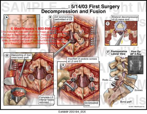 First Surgery Decompression And Fusion Medical Exhibit Medivisuals