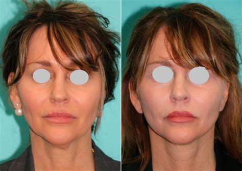Facelift Photos Chevy Chase Md Patient