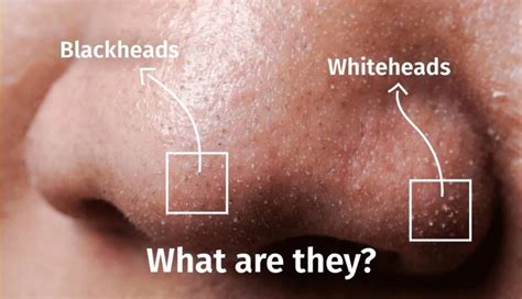What Are Whiteheads And How To Get Rid Of Them Depology
