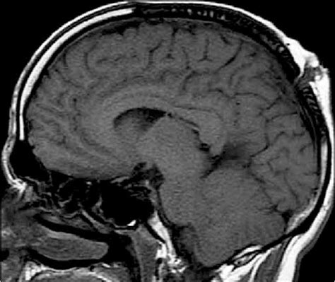 Figure 1 From Recurrent Atretic Parietal Cephalocele In Adult And