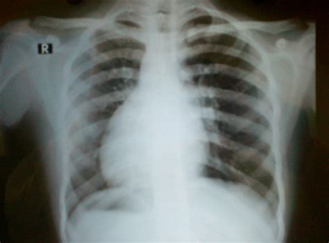 Healthforheart Situs Inversus Dextrocardia Associated Corrected T