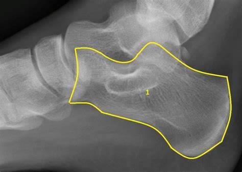 Severs Disease Calcaneal Apophysitis Ankle Foot And Orthotic Centre
