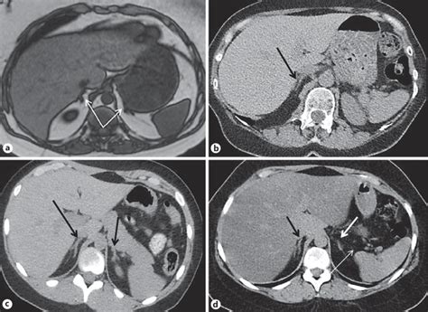 Mri And Ct Scan Findings A Mri In Case A Ii 1 Showed Normal Adrenal