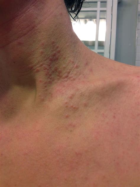 My Journey With Itchy Skin A Tough 3 Weeks Herpes Outbreak On Neck