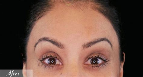 Brow Lift Types And Cost Breakdown