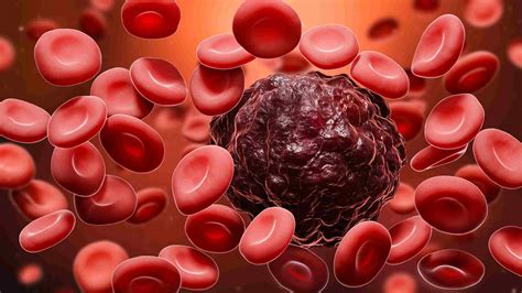 10 Causes For Blood Cancer That You Should Never Ignore Medical Island