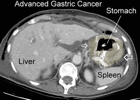Stomach Cancer On Ct Scan