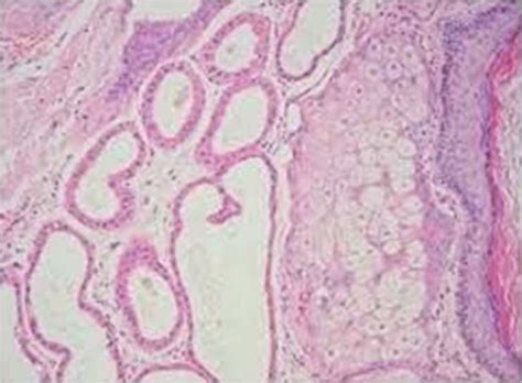 Dermoid Cyst An Unusual Location Bmj Case Reports