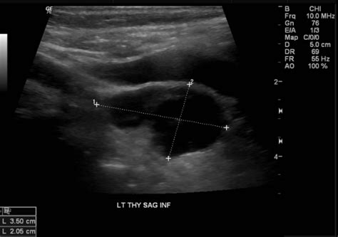Cureus A Rare Case Of Severe Hypercalcemia Secondary To Atypical