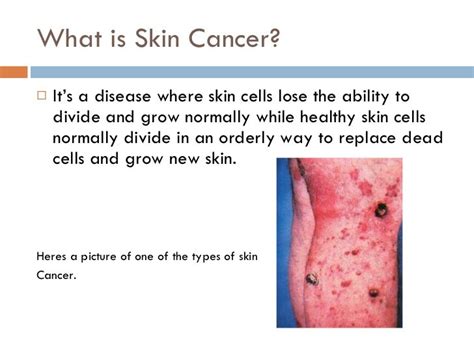 What Causes Skin Cancer