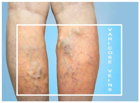 Are Varicose Veins Dangerous Is It Possible To Treat Varicose Veins