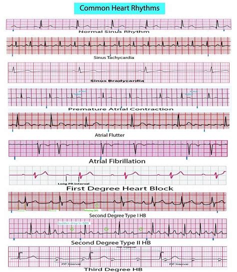 Common Heart Rhythms A Comprehensive Field Reference For 12 Lead Ekg