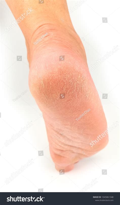 Women Flaking Skin Legs Cracked Heels Stock Photo 1045861348 Shutterstock