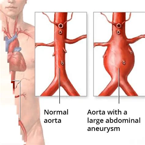 Aortic Aneurysm Causes Symptoms Treatment Venart Medical Clinic