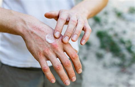 What You Need To Know About Adult Eczema Next Avenue