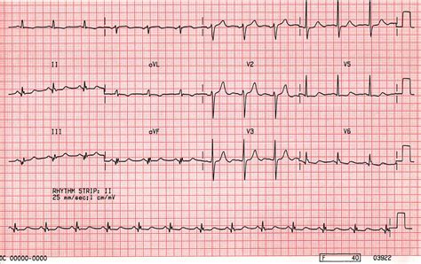 Case A3 Old Inferior Infarction With Lateral Stt Wave Changes St