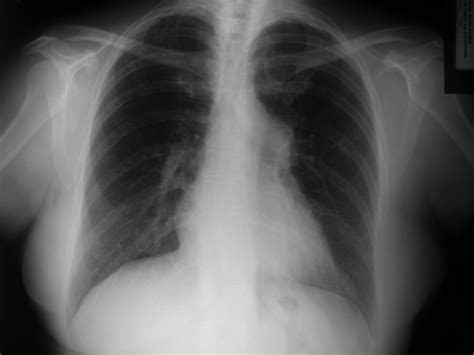 Embolia Pulmonar Causas Sintomas E Tratamento Imeb